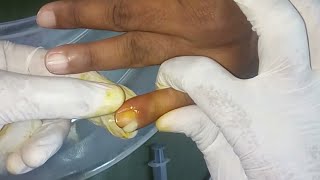 Pus popping out from ingrown nail
