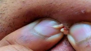 Ear Pimples, Nose Blackheads and Throat Stones!