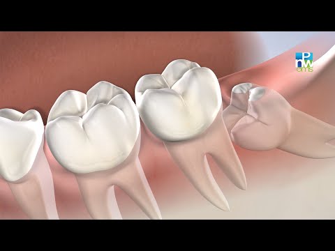 Post-Operative Instructions: Wisdom Teeth Removal | Pacific Northwest Oral & Maxillofacial Surgeons