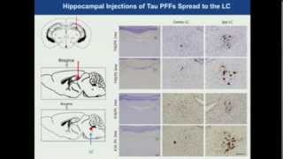 Transmission of misfolded proteins in neurodegenerative disorders (Dr. Virginia Lee}