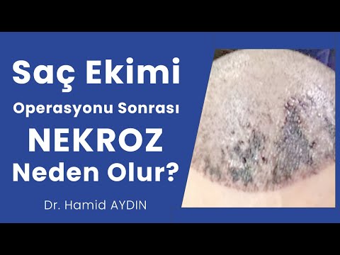 Saç Ekimi Operasyonu Sonrası Nekroz Neden ve Nasıl Olur?