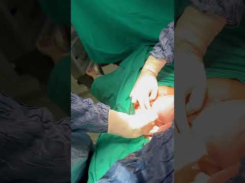  Breech Cesarean Section for a large 4.2 kg baby | Dr. Shrikant Khetmalas