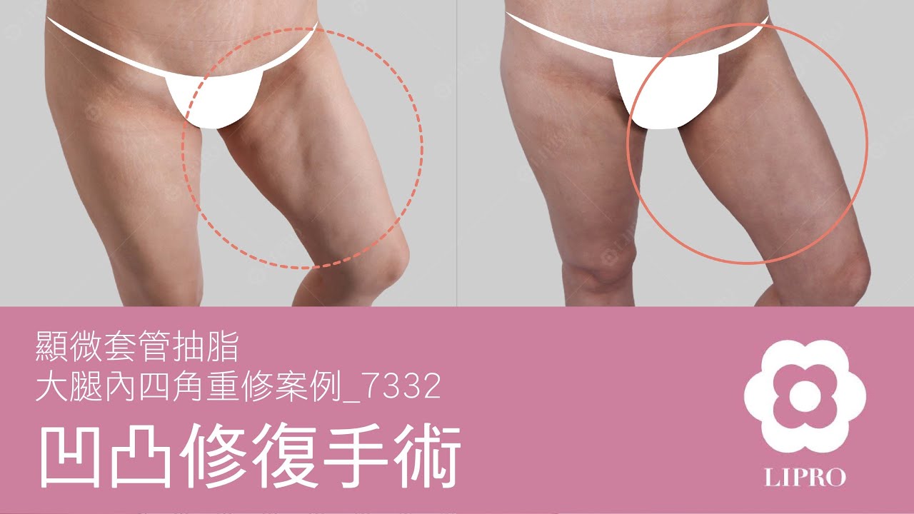 凹凸修復手術｜顯微套管抽脂｜大腿內四角重修案例_7332