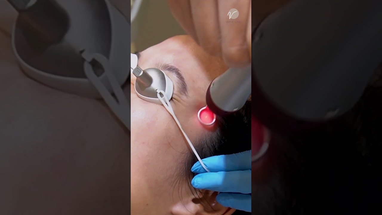 Get rid of freckles & melasma with Picoway Laser
