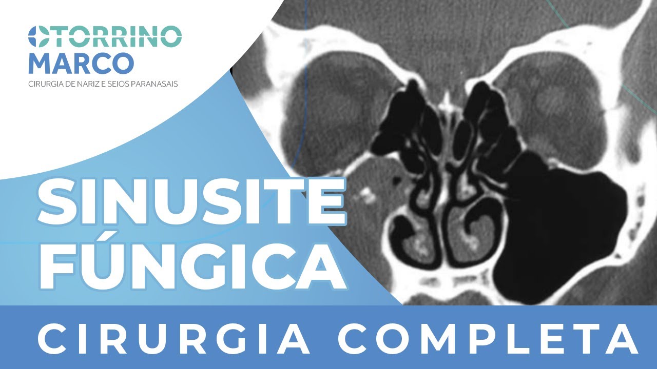 Sinusite Fúngica: Cirurgia Completa Sem Cortes - Otorrino Marco