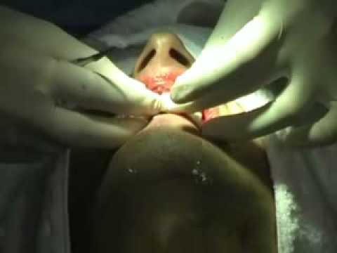 Dental Implant, Teeth In an Hour & Dental Crown - Dental Implant Rare surgery , India, Punjab