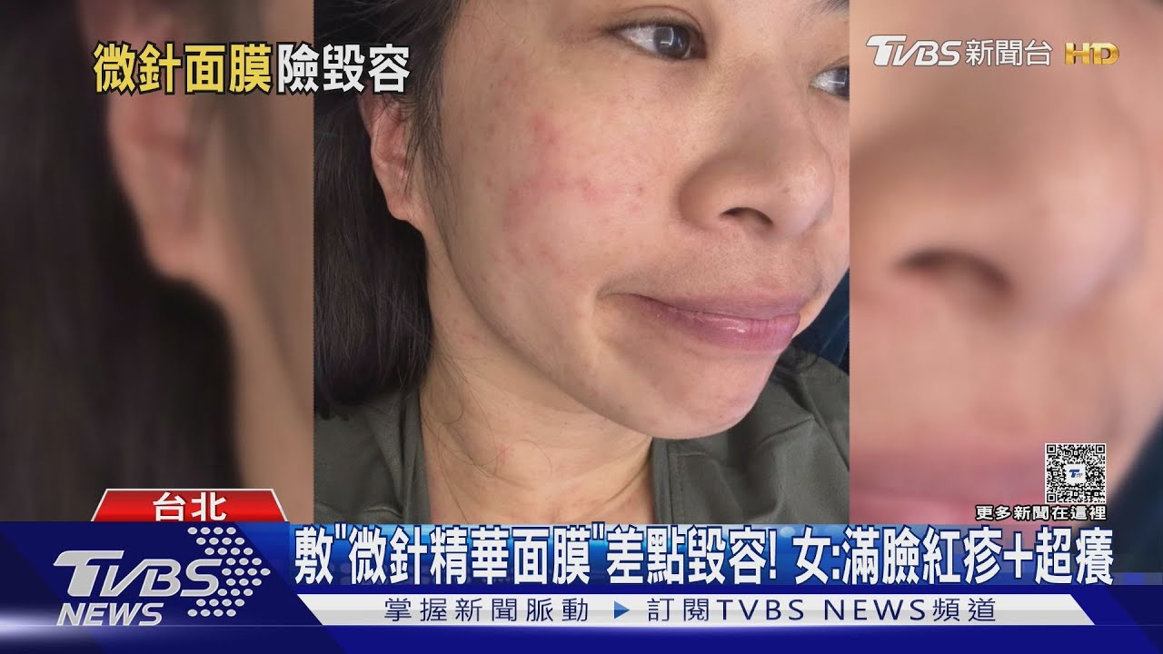敷「微針精華面膜」差點毀容！　女：滿臉紅疹、超癢