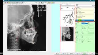Guide to Using Cephalometric Analysis Software
