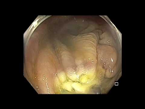 Coloscopie: LST-G du cæcum, résection difficile - partie 1