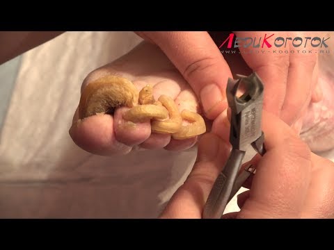 Gribok der Nägel auf der Nägel die Behandlung die Präparate die preiswerten aber ergebnisreichen Rez Gribok auf dem Nagel des Beines sind was besser