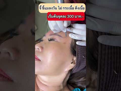 รีวิวหัตถการโปรแกรม CO2 Laser
