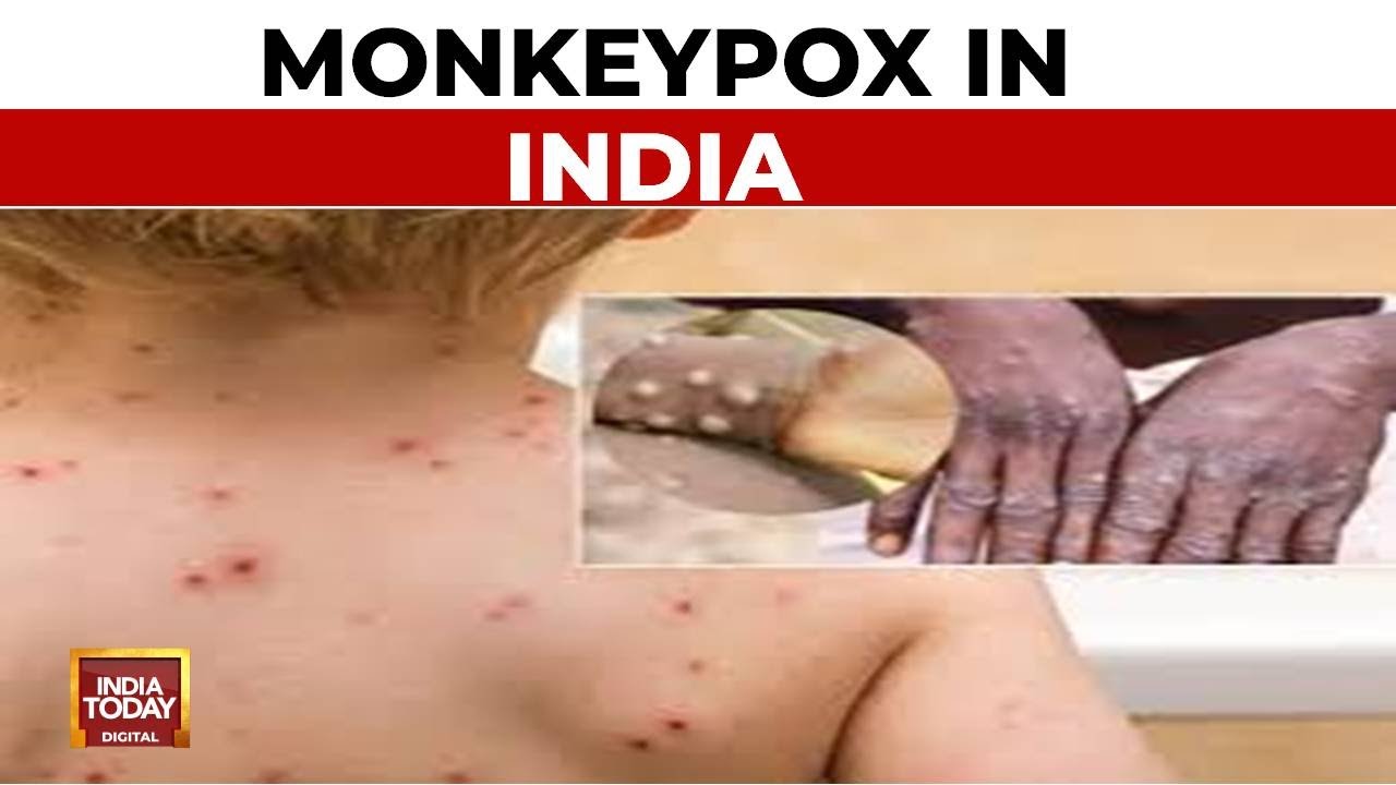 Mpox Case Detected In Man Not From Current Outbreak, No Risk To Public: Centre