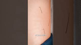 Download lagu What’s Inside A Pilonidal Cyst? 😨 mp3