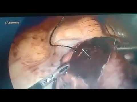 Laparoscopic Fibroid Removal