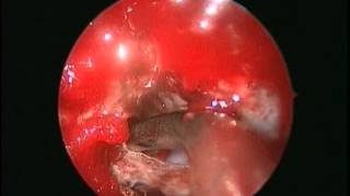 preview picture of video 'Colesteatoma de region petroclival operado por via endoscópica'