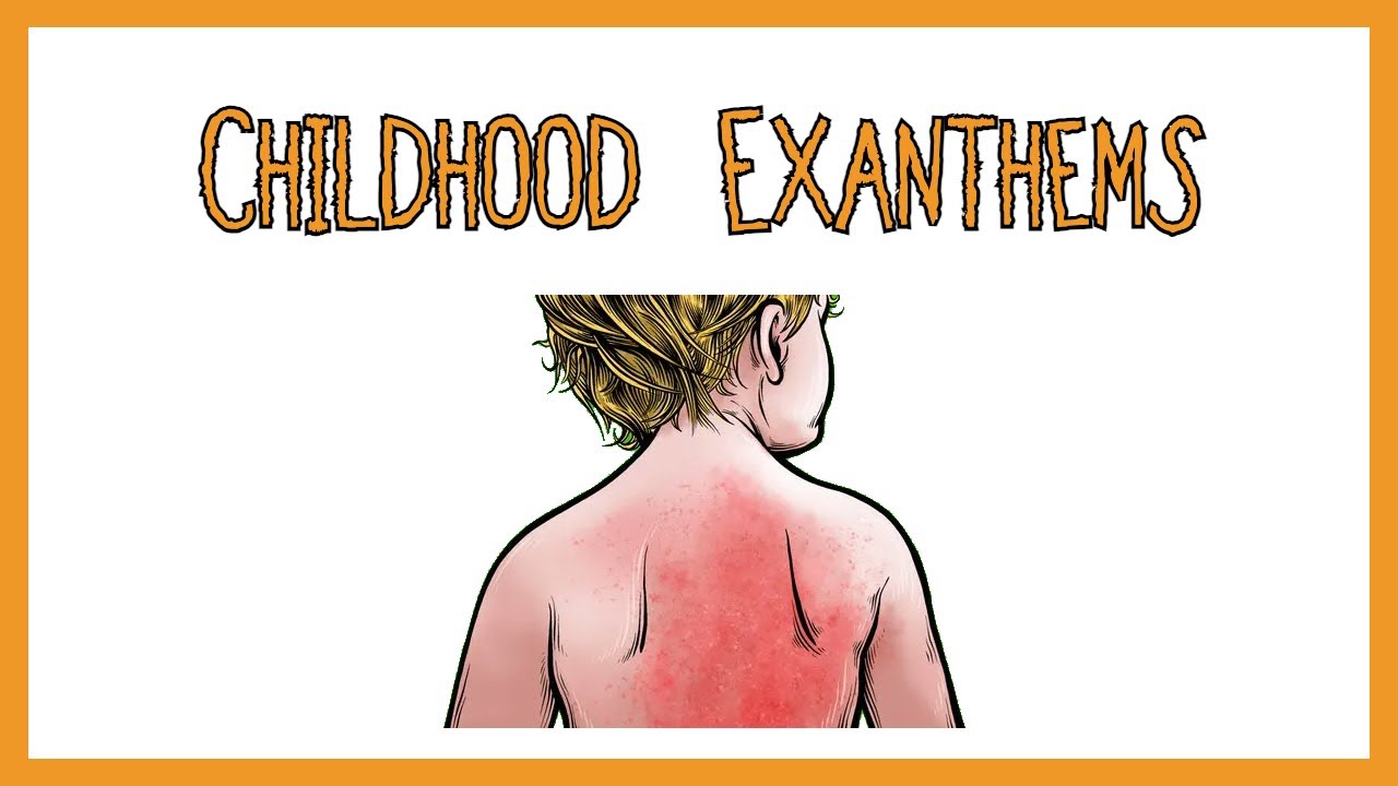 Childhood Exanthems (rash)