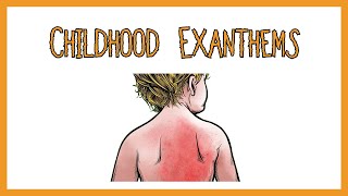 Childhood Exanthems (rash)