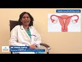 Fallopian Tube Blockage: Symptoms, Causes, Diagnosis and Treatment Fallopian Tube Blockage: Symptoms, Causes, Diagnosis and Treatment
