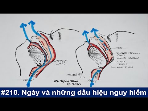 Ngáy và những dấu hiệu bệnh nguy hiểm