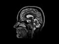 3D T2 brain MRI imaging