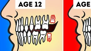 Do You Really Need to Get Your Wisdom Teeth Pulled?