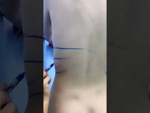 Así se realiza la marcación previa para lipoescultura - Barranquilla -  Dra. Claudia Nobmann