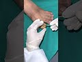 MASSIVE INGROWN TOENAIL REMOVAL Toe Nail Surgery Skinaa Clinic Viral Shorts Skinaa Clinic