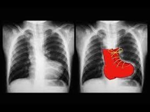 RADIOLOGY  CVS IBQ - HIGH YIELD TOPIC FOR PG EXAM