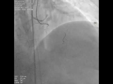 Retrograde approach to RCA CTO