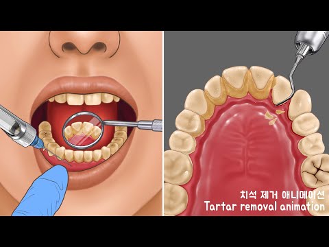 Eliminacion de Sarro