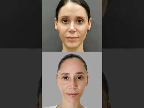 Facelifts at 40 with Dr. Sam Rizk