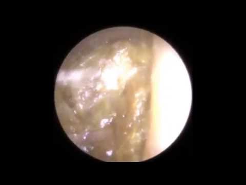 Ear Wax Removal Leicester - Mr Neel Raithatha (The...