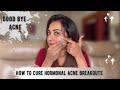 Hormonal Breakouts Active Acne Here S The One Stop Solution Nua Acne Control JananiAshokkumar