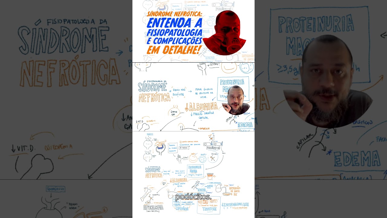 Entendendo a Síndrome Nefrótica - #síndromenefrótica #proteinúria #edema #nefrologia #fisiopatologia