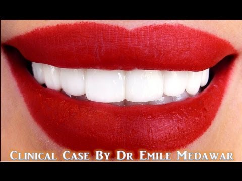 Hollywood smile Beirut Lebanon at style dental clinic by dentist Dr Emile Medawar