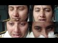 Nose Blowing Sneezing Challenge Requested Video