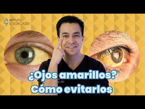 Ojos amarillos ¿Cómo evitarlos?