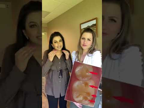 Acid Reflux 💥 #acidreflux #fyp #fypage #dentist #dentaltips