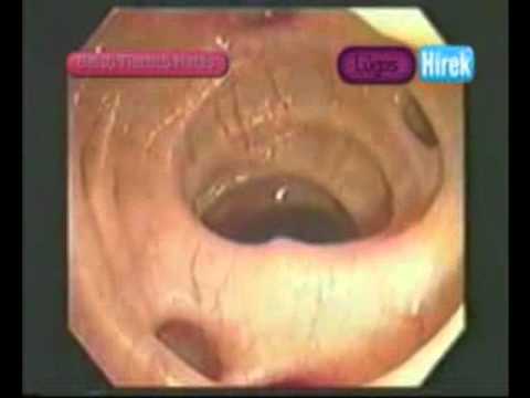 Vestibularis papillomatosis rigó