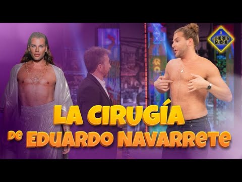 Las operaciones estéticas de Eduardo Navarrete - El Hormiguero