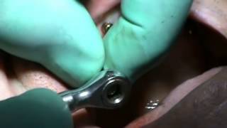 Implantes Dentales - Primera Intervención - Dr. Mikel Florit