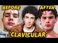 Clavicular: The Internet's Prettiest Incel DEFAULT Thumbnail