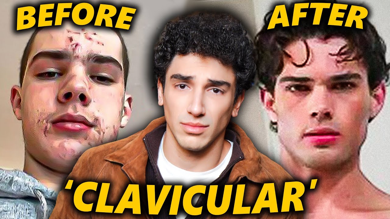 Clavicular: The Internet's Prettiest Incel