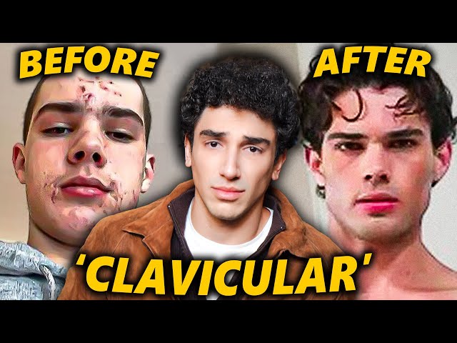 Clavicular: The Internet's Prettiest Incel SDDEFAULT Thumbnail