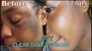 How to clear dark sunburn naturally fast