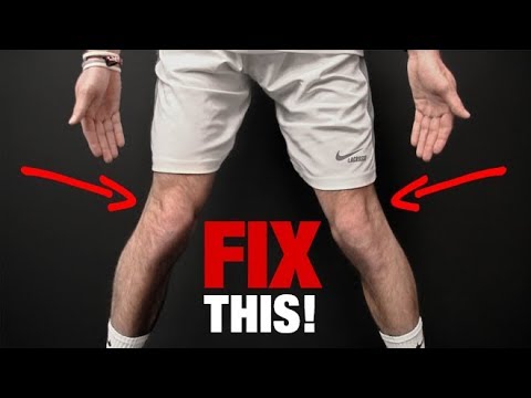 How to Fix Knee Valgus (KNEES THAT CAVE IN!)