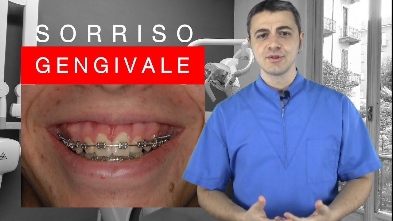 Sorriso gengivale