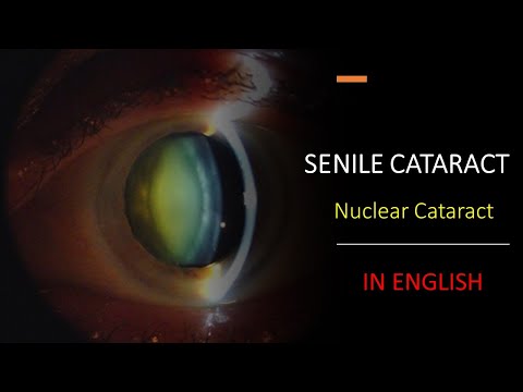 SENILE CATARACT | NUCLEAR CATARACT | HARD CATARACT