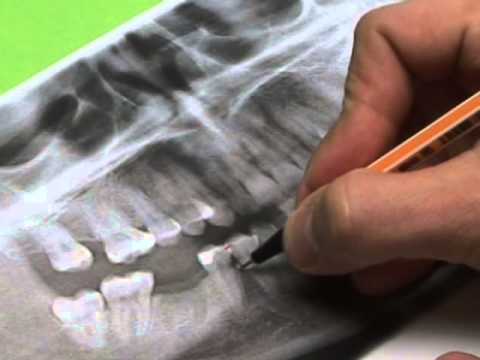 OrthoEasy - Unterkiefer - Planung am OPG