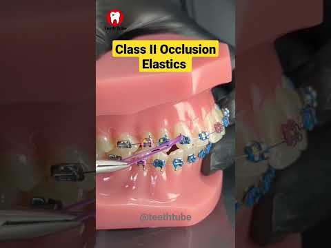 Class II Occlusion Elastics #shortvideo #shorts #elastics